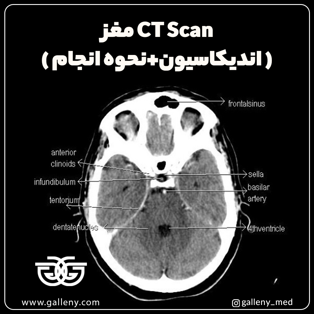 CT Scan مغز [اندیکاسیون+نحوه انجام] – گالنی