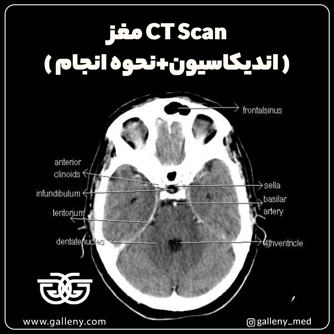 CT Scan مغز [اندیکاسیون+نحوه انجام]