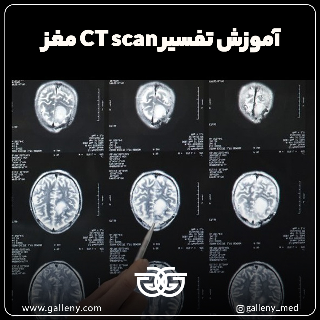 آموزش تفسیر CT scan مغز