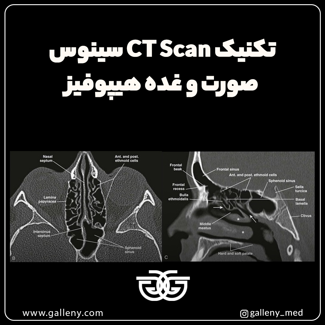 تکنیک CT Scan سینوس ،صورت و غده هیپوفیز