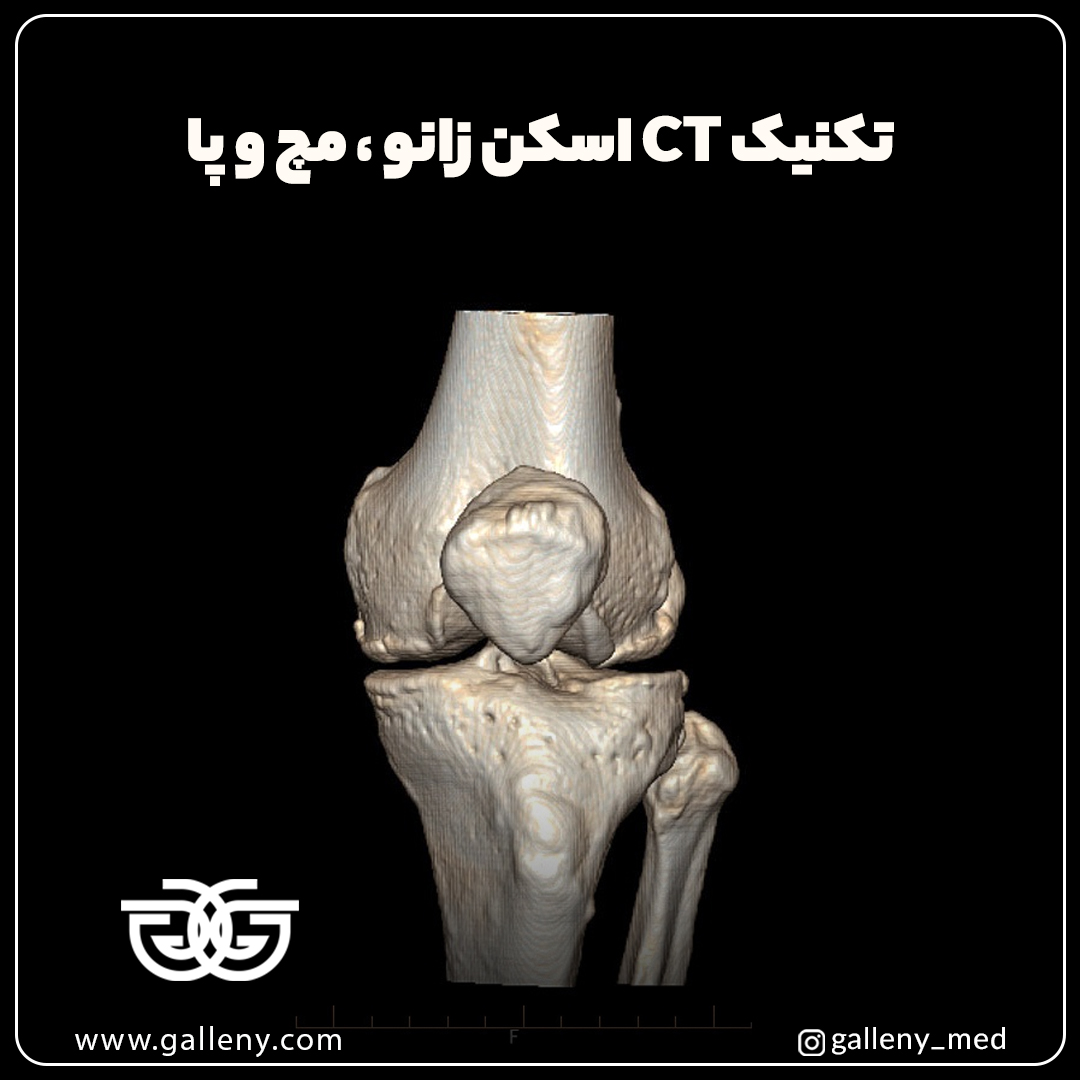 تکنیک CT اسکن زانو ، مچ و پا